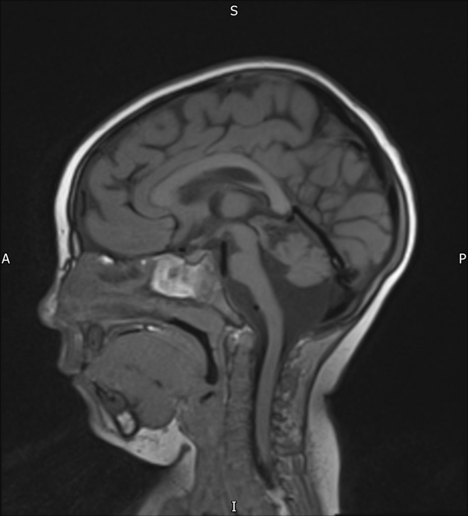 Image of an MRI of a child's head