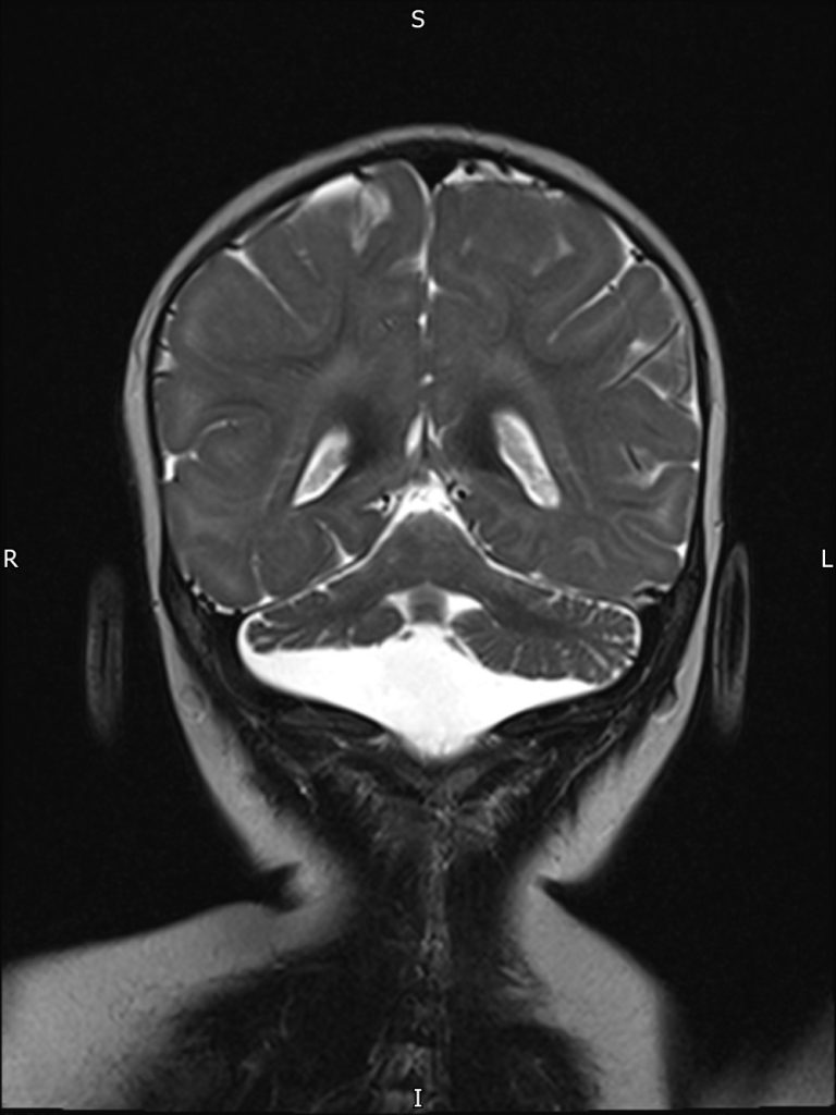 A Coronal view of an MRI of a CASK patient